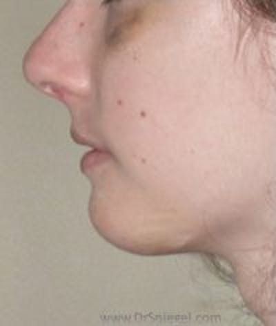 Chin Augmentation Before & After Gallery - Patient 409479 - Image 2