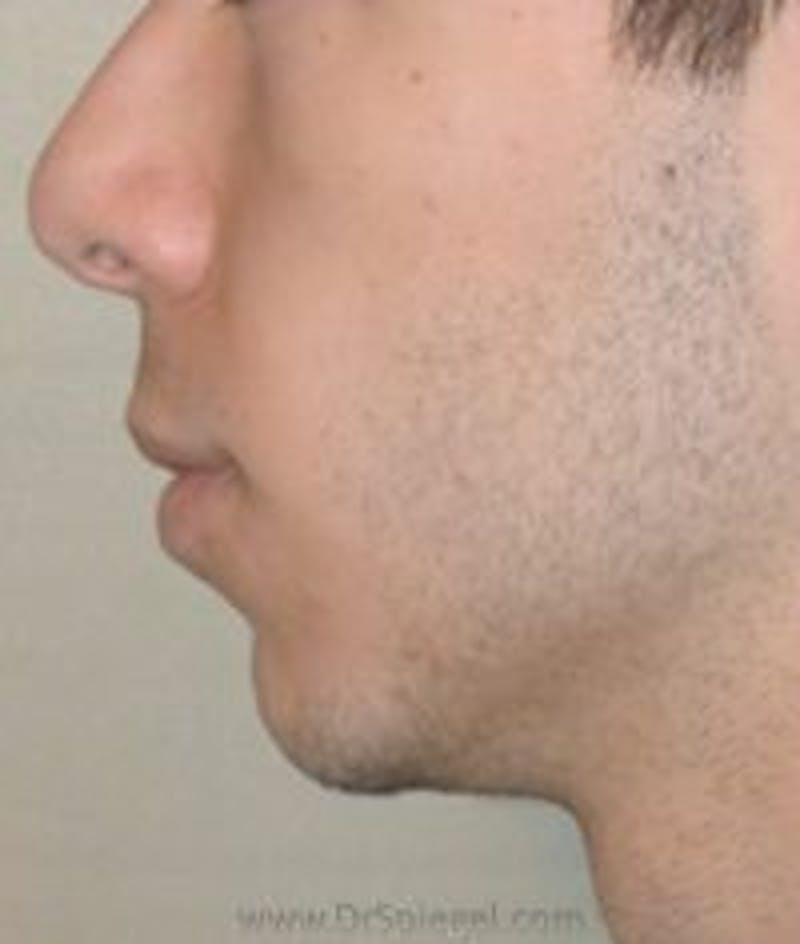 Chin Augmentation Before & After Gallery - Patient 218699 - Image 1