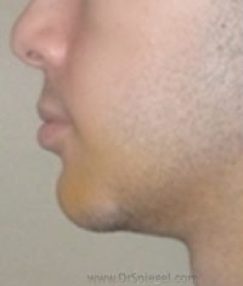 Chin Augmentation Before & After Gallery - Patient 218699 - Image 2