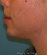 Chin Augmentation Before & After Gallery - Patient 306669 - Image 2