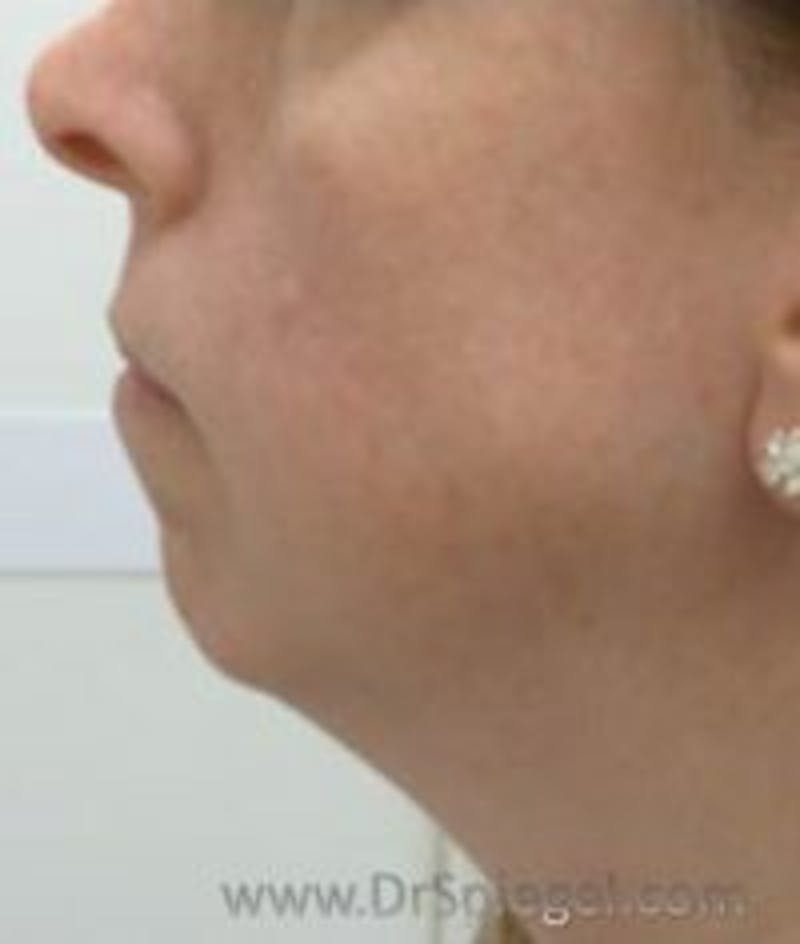 Chin Augmentation Before & After Gallery - Patient 171682 - Image 1