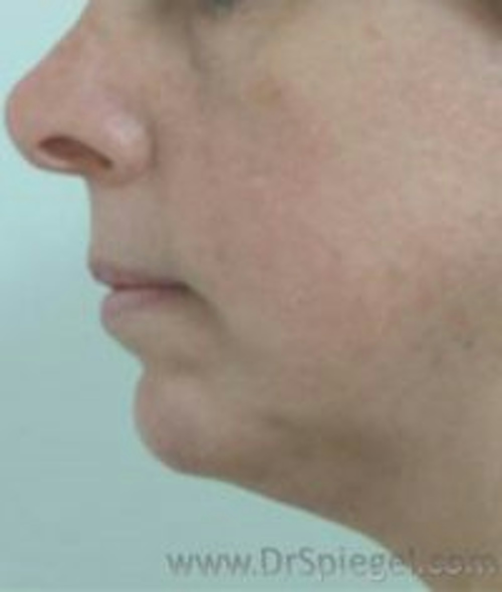 Chin Augmentation in Boston Before and After Photos