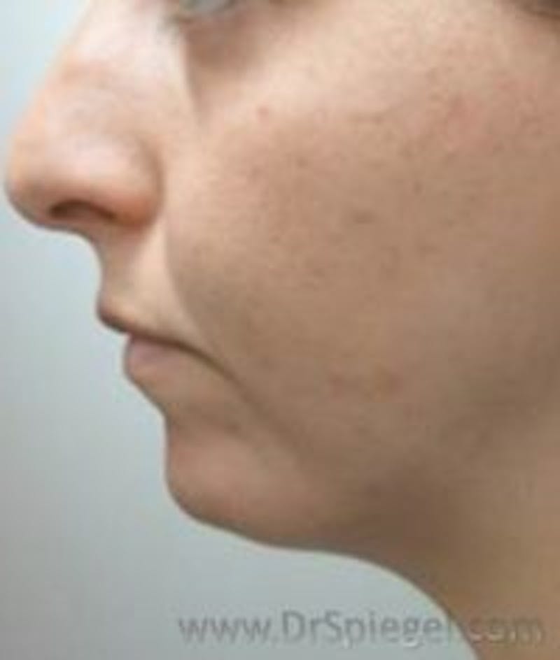 Chin Augmentation Before & After Gallery - Patient 171817 - Image 2