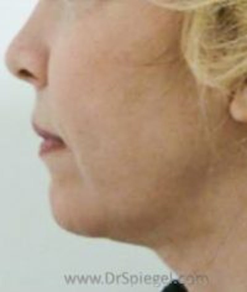 Chin Augmentation Before & After Gallery - Patient 994782 - Image 2