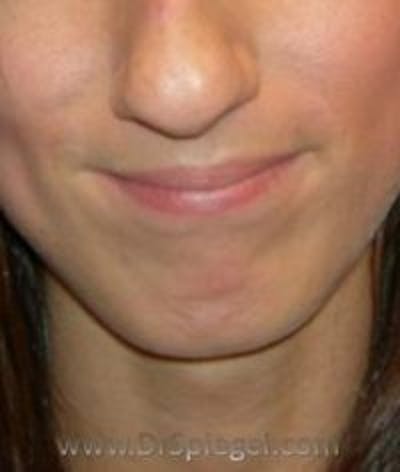 Chin Augmentation Before & After Gallery - Patient 200342 - Image 1