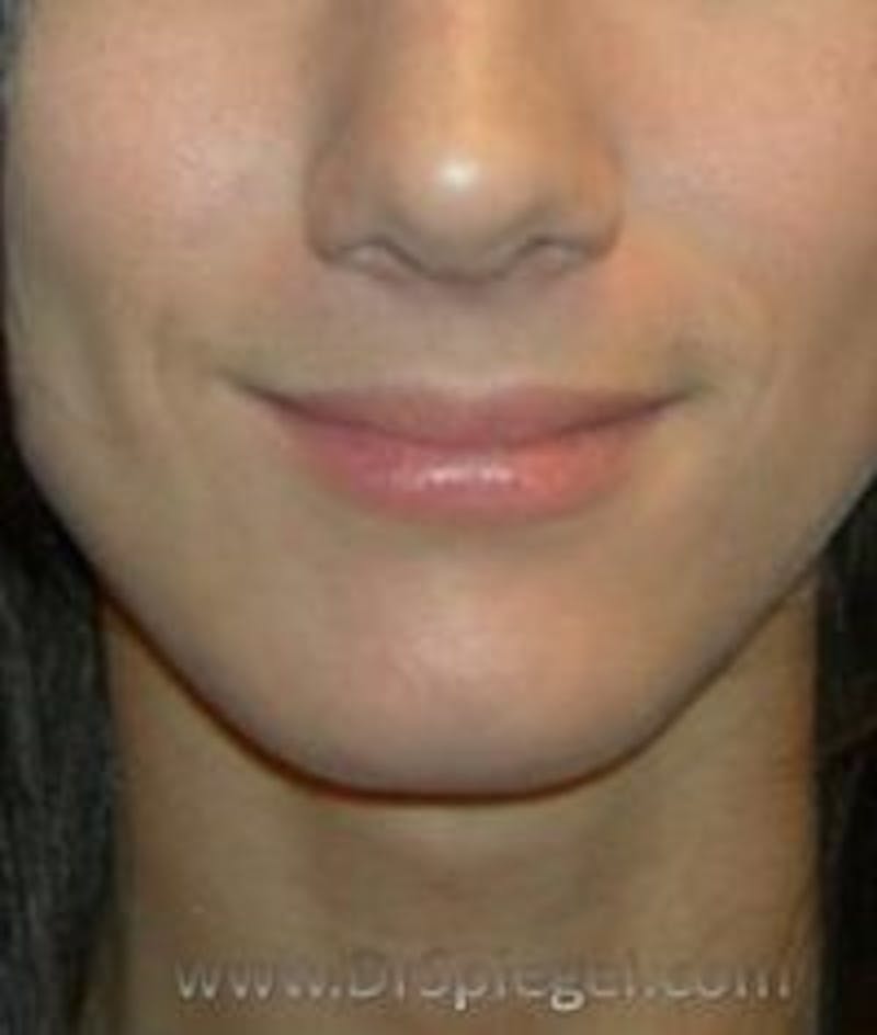 Chin Augmentation Before & After Gallery - Patient 200342 - Image 2