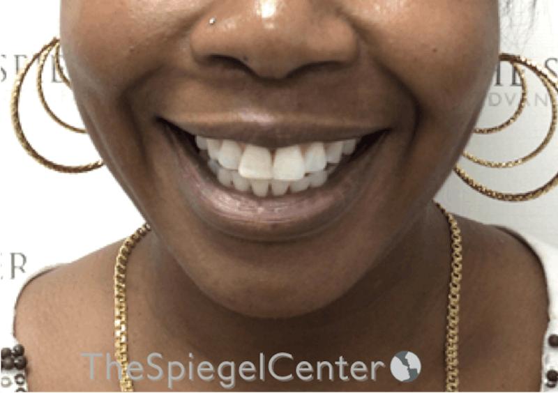 Dimpleplasty Before & After Gallery - Patient 132361 - Image 1