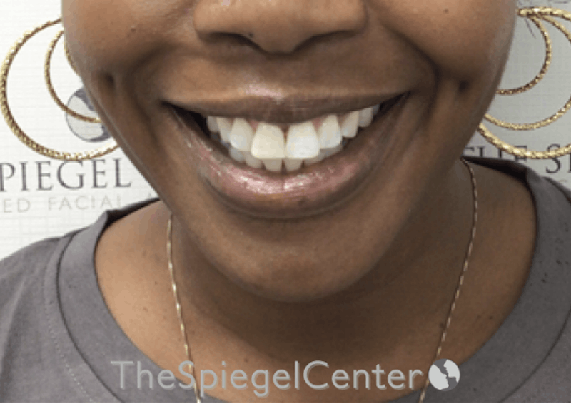 Dimpleplasty Before & After Gallery - Patient 132361 - Image 2