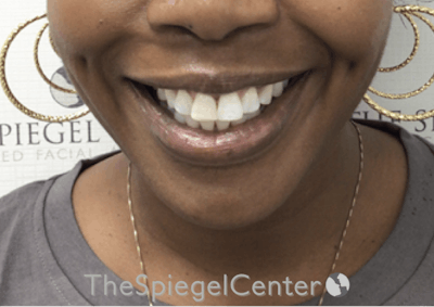 Dimpleplasty Before & After Gallery - Patient 132361 - Image 2