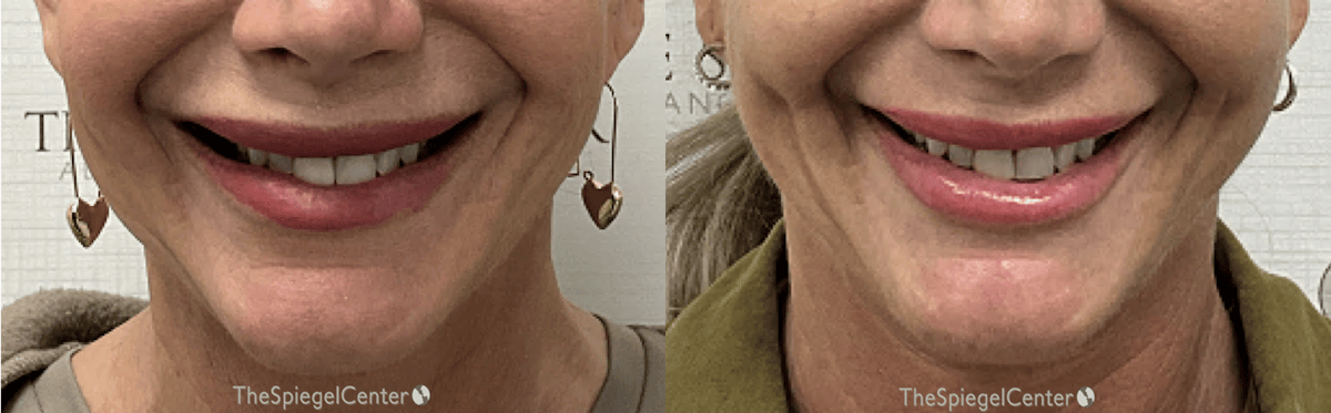 Dimpleplasty Before & After Gallery - Patient 428803 - Image 1