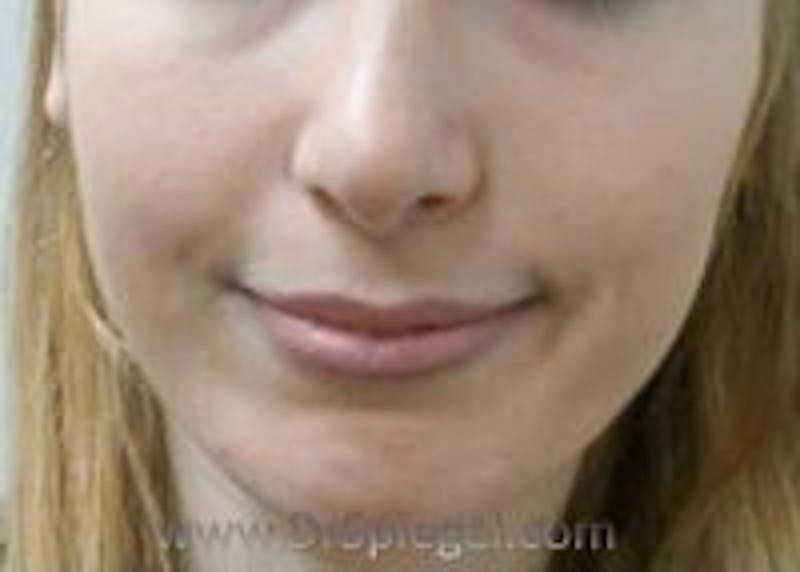 Dimpleplasty Before & After Gallery - Patient 260538 - Image 1