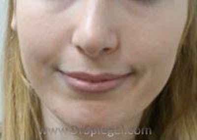 Dimpleplasty Before & After Gallery - Patient 260538 - Image 1