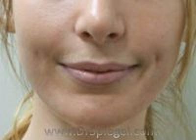 Dimpleplasty Before & After Gallery - Patient 260538 - Image 2