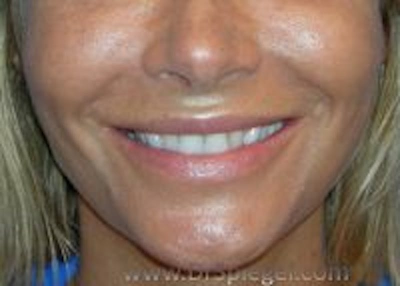 Dimpleplasty Before & After Gallery - Patient 878331 - Image 1