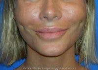 Dimpleplasty Before & After Gallery - Patient 878331 - Image 2
