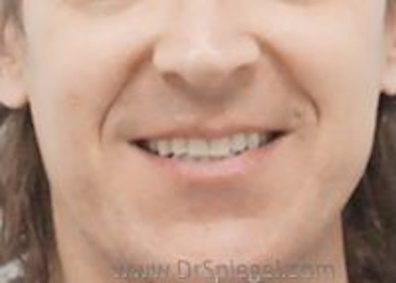 Dimpleplasty Before & After Gallery - Patient 274833 - Image 1