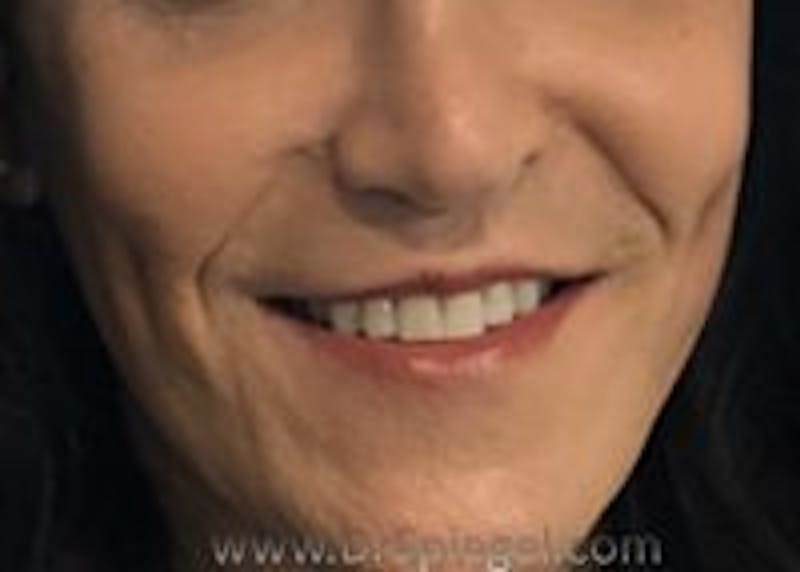 Dimpleplasty Before & After Gallery - Patient 274833 - Image 2