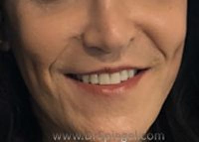 Dimpleplasty Before & After Gallery - Patient 274833 - Image 2