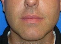 Dimpleplasty Before & After Gallery - Patient 340489 - Image 1