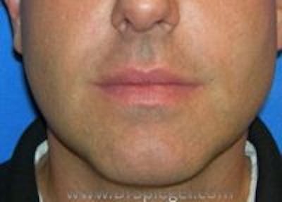 Dimpleplasty Before & After Gallery - Patient 340489 - Image 1