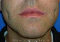 Dimpleplasty Before & After Gallery - Patient 340489 - Image 2