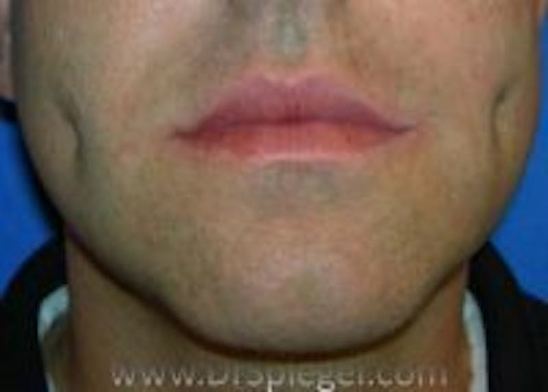 Dimpleplasty Before & After Gallery - Patient 340489 - Image 2