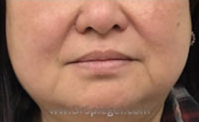 Dimpleplasty Before & After Gallery - Patient 421038 - Image 1