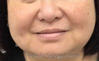 Dimpleplasty Before & After Gallery - Patient 421038 - Image 2