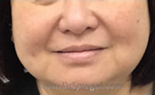 Dimpleplasty Before & After Gallery - Patient 421038 - Image 2