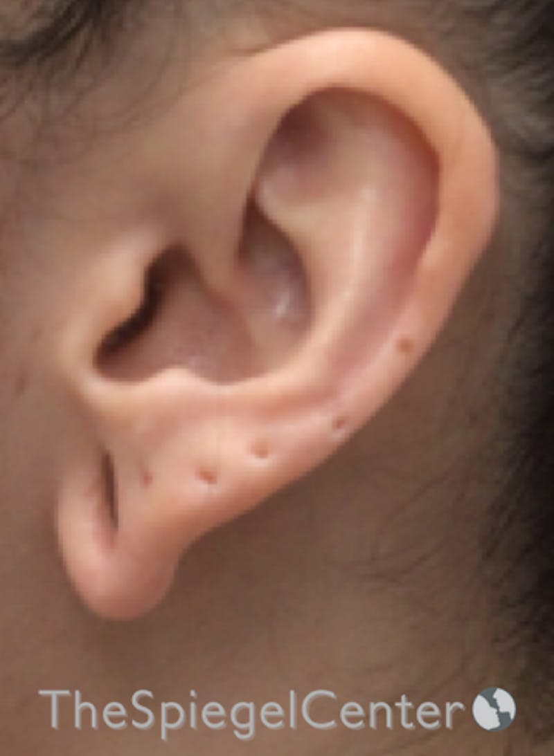 Ear Lobe Repair Before & After Gallery - Patient 269623 - Image 1