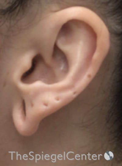 Ear Lobe Repair Before & After Gallery - Patient 269623 - Image 1