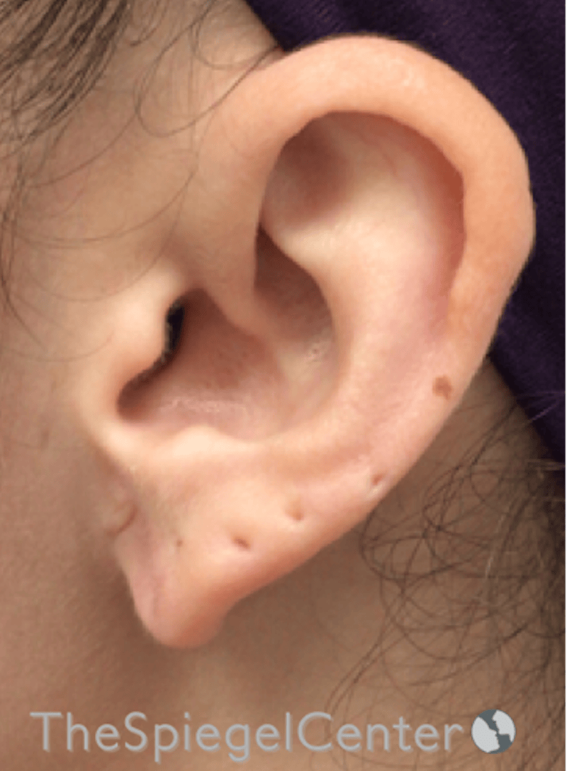 Ear Lobe Repair Before & After Gallery - Patient 269623 - Image 2