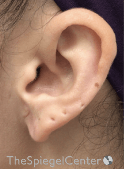 Ear Lobe Repair Before & After Gallery - Patient 269623 - Image 2