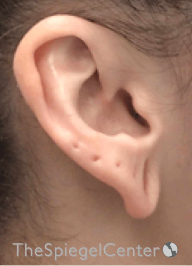 Ear Lobe Repair Before & After Gallery - Patient 269623 - Image 3