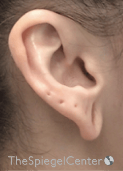 Ear Lobe Repair Before & After Gallery - Patient 269623 - Image 3