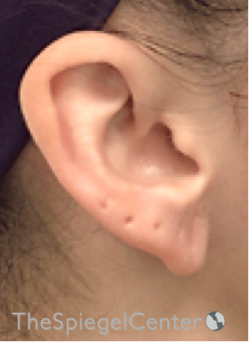 Ear Lobe Repair Before & After Gallery - Patient 269623 - Image 4
