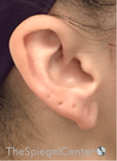 Ear Lobe Repair Before & After Gallery - Patient 269623 - Image 4
