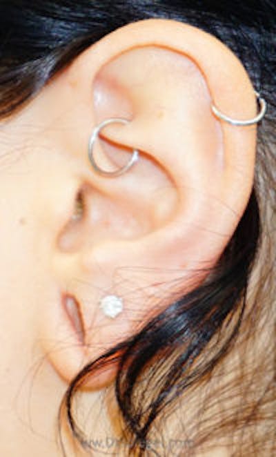 Ear Lobe Repair Before & After Gallery - Patient 429443 - Image 1