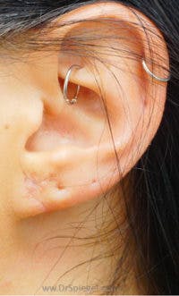 Ear Lobe Repair Before & After Gallery - Patient 429443 - Image 2