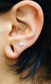 Ear Lobe Repair Before & After Gallery - Patient 429443 - Image 3