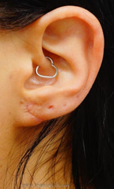 Ear Lobe Repair Before & After Gallery - Patient 429443 - Image 4