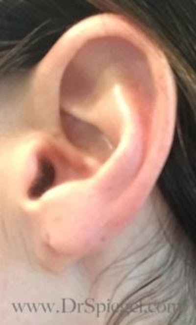 Ear Lobe Repair Before & After Gallery - Patient 956122 - Image 1