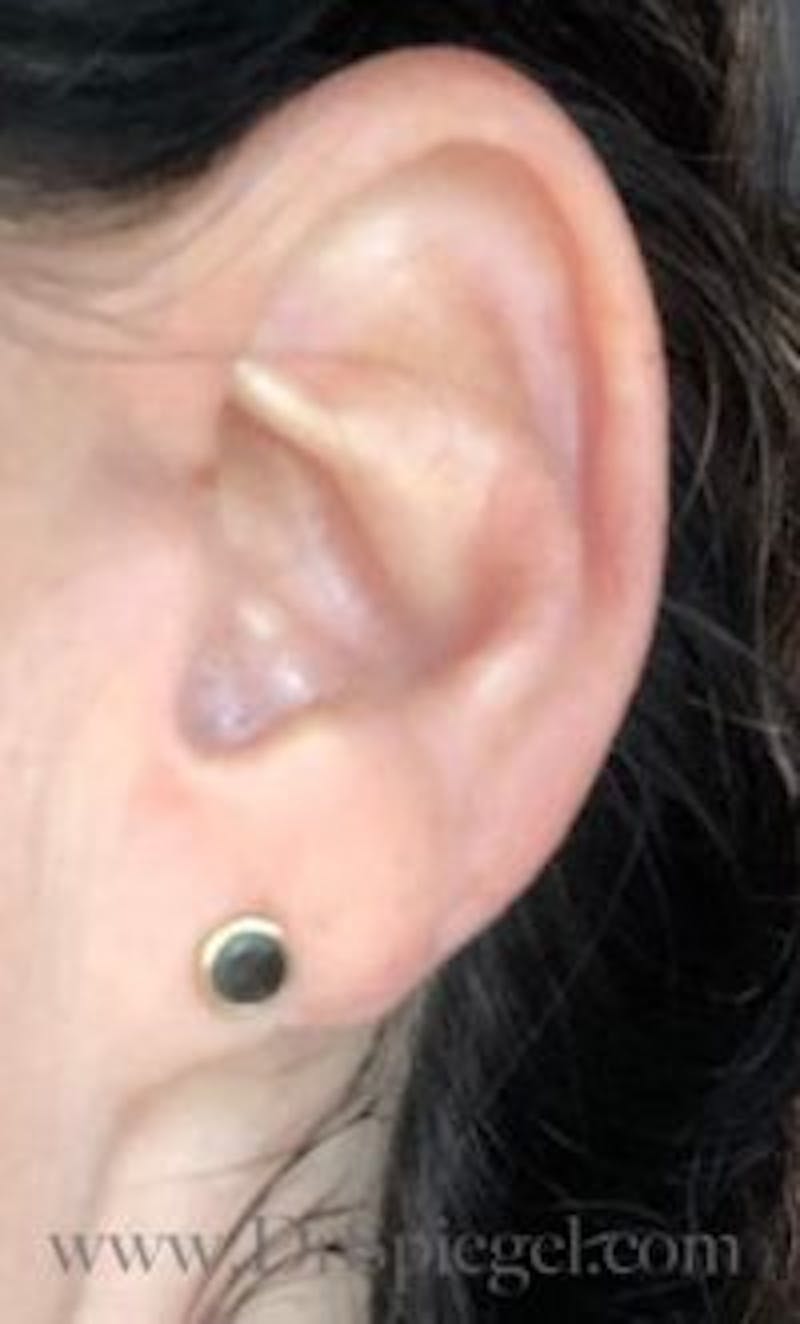 Ear Lobe Repair Before & After Gallery - Patient 956122 - Image 2