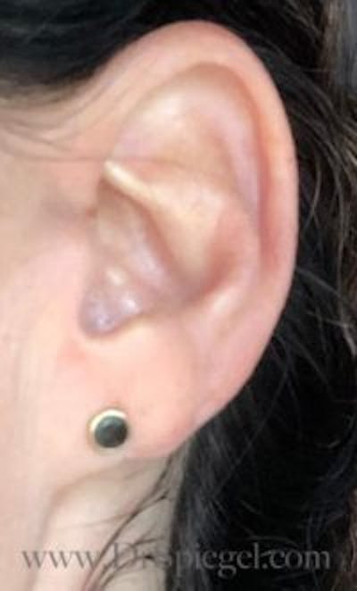 Ear Lobe Repair Before & After Gallery - Patient 956122 - Image 2