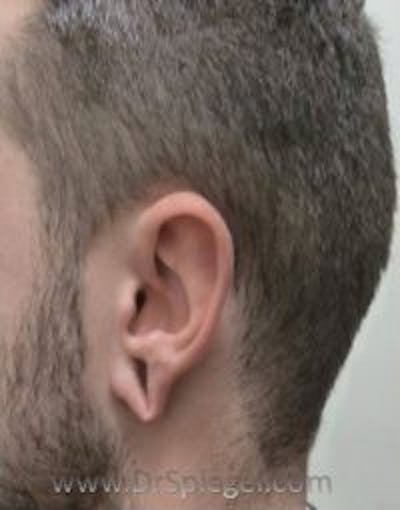 Ear Lobe Repair Before & After Gallery - Patient 422883 - Image 1