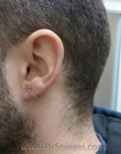Ear Lobe Repair Before & After Gallery - Patient 422883 - Image 2