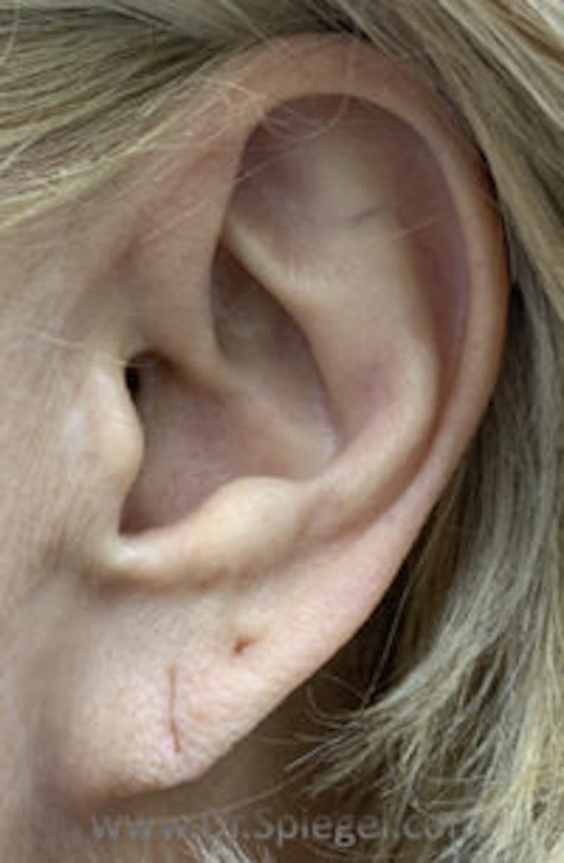 Ear Lobe Repair Before & After Gallery - Patient 363010 - Image 1
