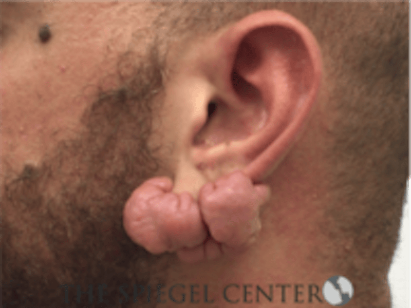 Ear Lobe Repair Before & After Gallery - Patient 819105 - Image 1