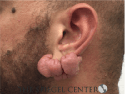 Ear Lobe Repair Before & After Gallery - Patient 819105 - Image 1