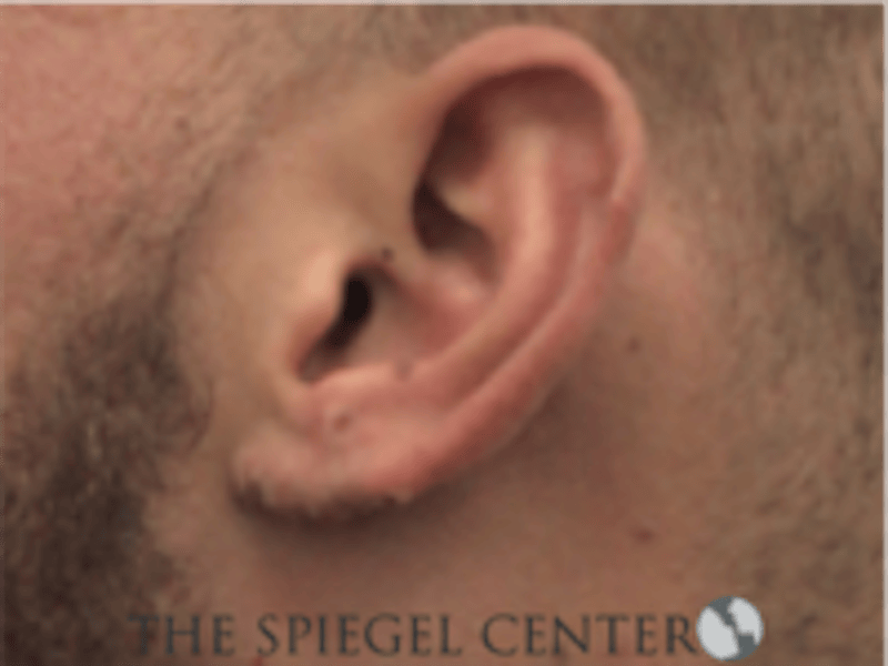Ear Lobe Repair Before & After Gallery - Patient 819105 - Image 2